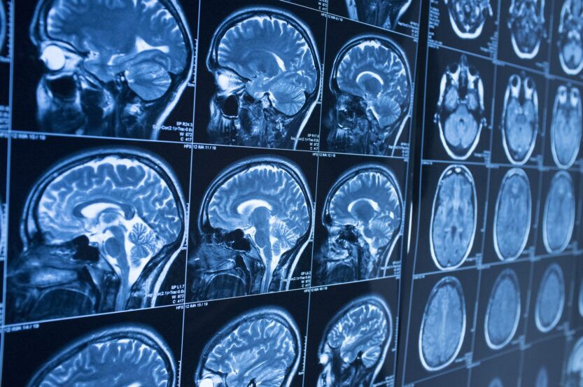 Nerve Damage After Surgery